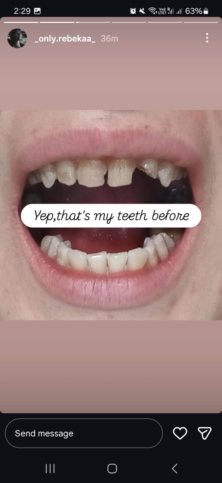 Rebeka's Instagram story — Yep, that's my teeth before