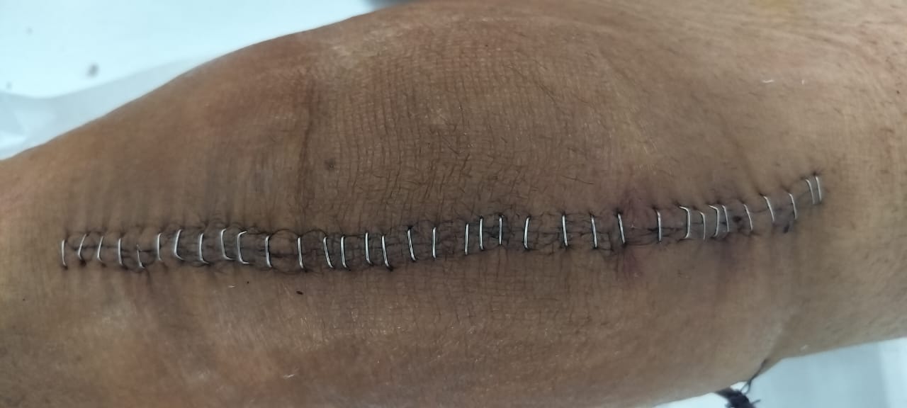 Post-surgery stitches