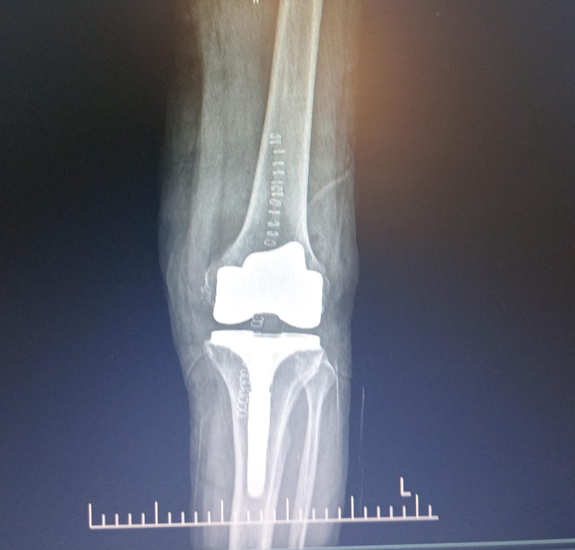X-ray — knee implant front view