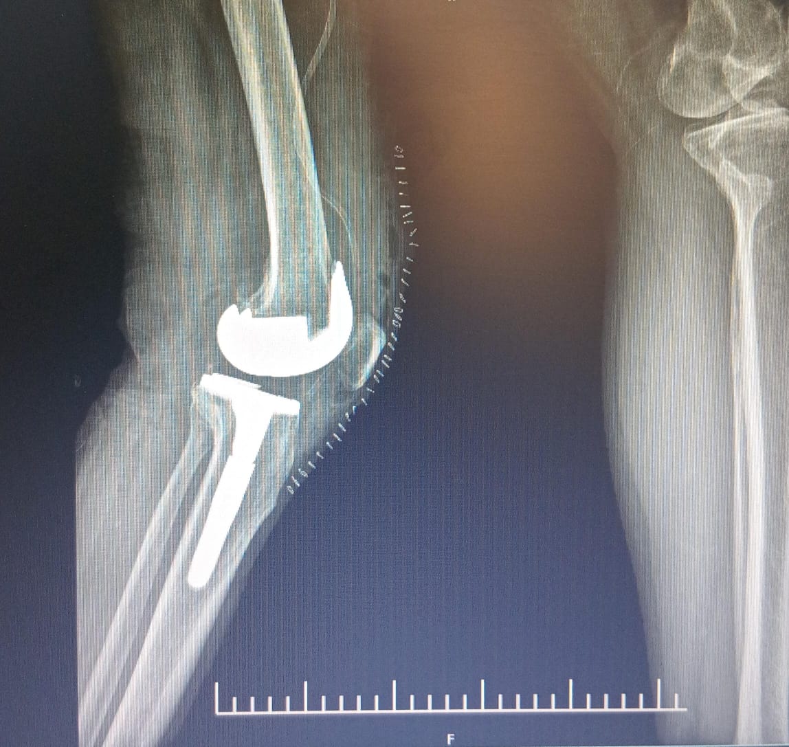 X-ray — knee implant side view